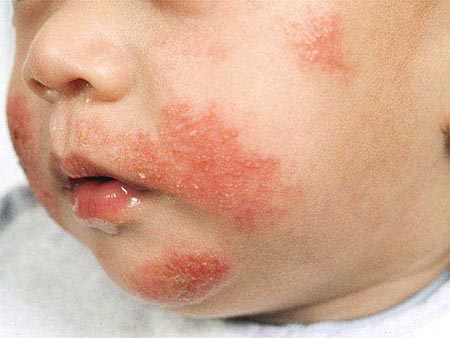Аллергическая сыпь у ребенка на лямблиоз