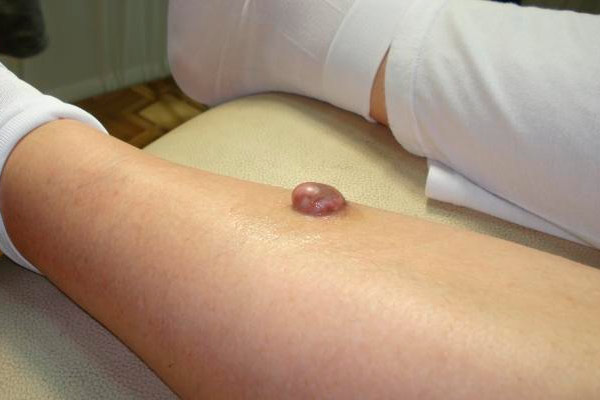 Фиброма Кожи Гистология У Человека Фото