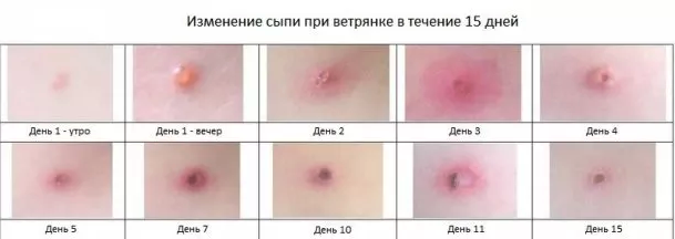 Изменение сыпи при ветрянке в течение 15 дней