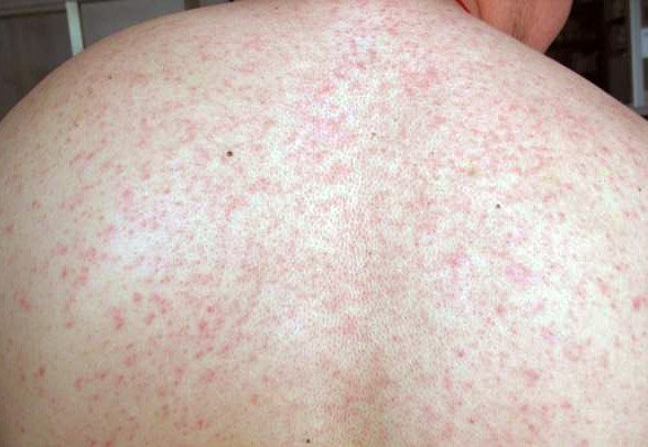 Сыпь на спине при сифилисе фото thumbnail