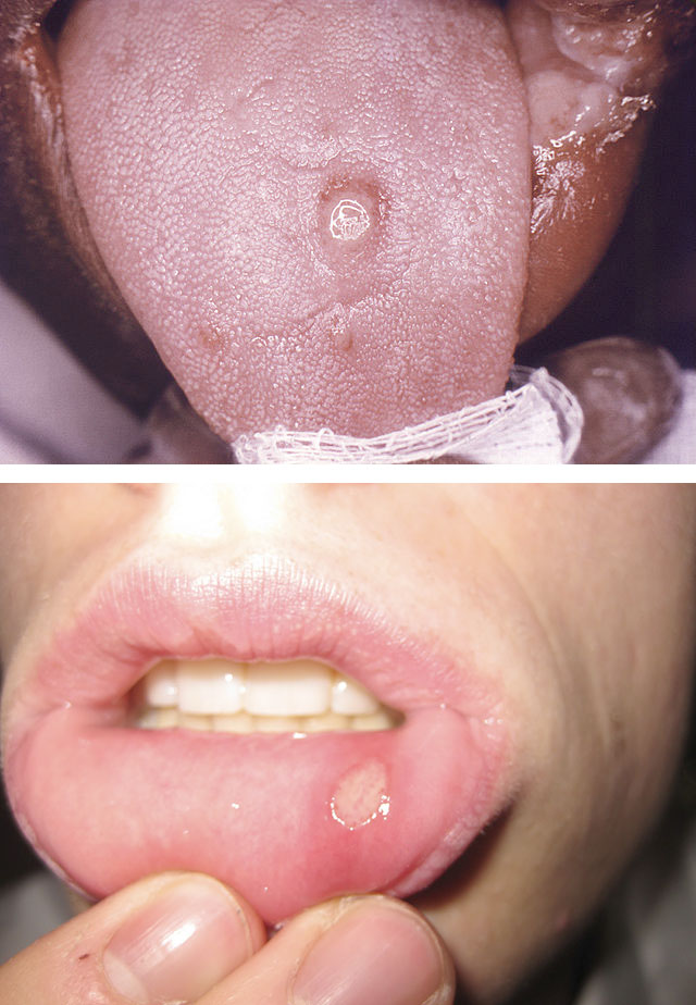Первичный сифилис на губе и языке фото