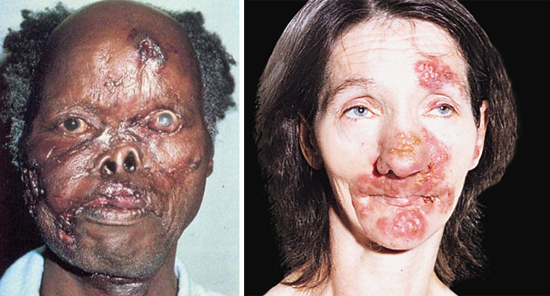 Последствия третичного сифилиса фото