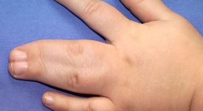 Синдактилия пальцев рук