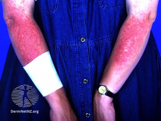 Контактный дерматит на руках от солнца фото
