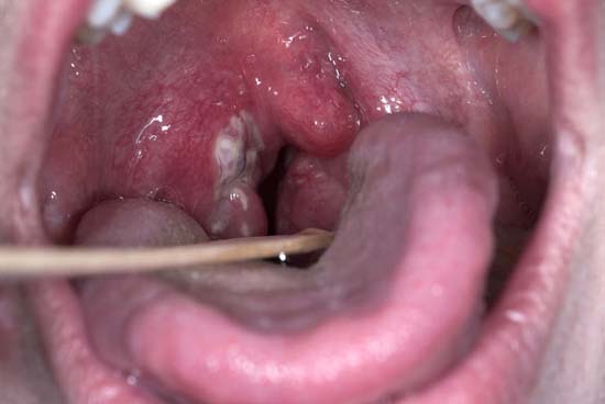 Фото больного горла у взрослых и название болезни thumbnail