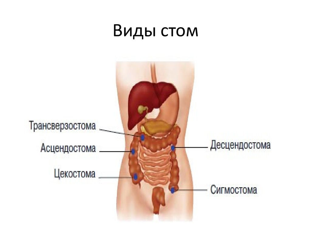 виды стом