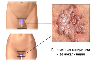 генитальная кондилома на фото