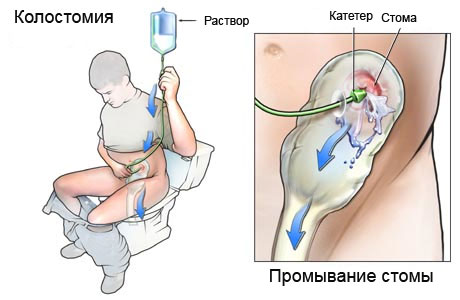 промывание стомы фото