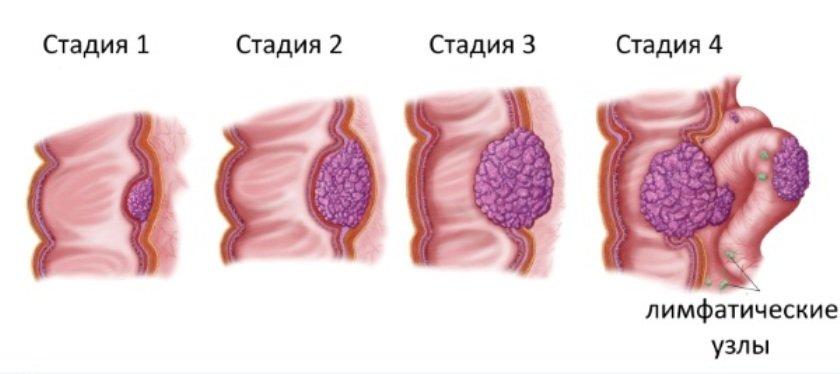 стадии рака кишечника