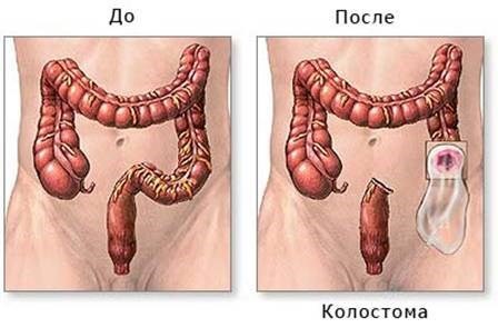 фото до и после колостомы