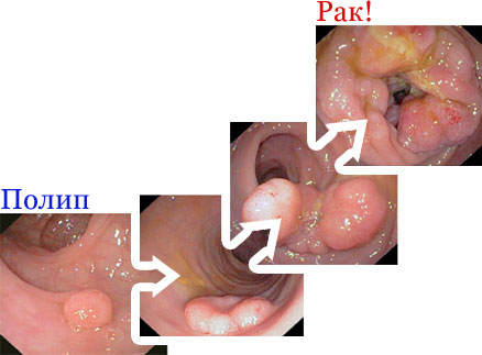 фото развитие рака кишечника