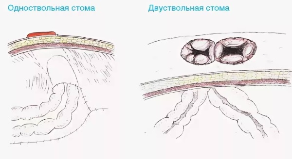 Колостома двуствольная схема