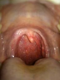 Фото больного горла у взрослых и название болезни
