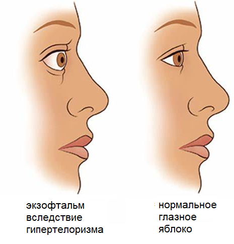 Базедова болезнь картинки