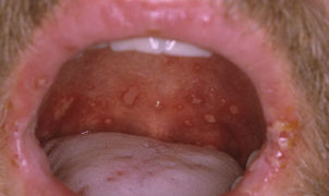 Высыпания во рту при вторичном сифилисе фото