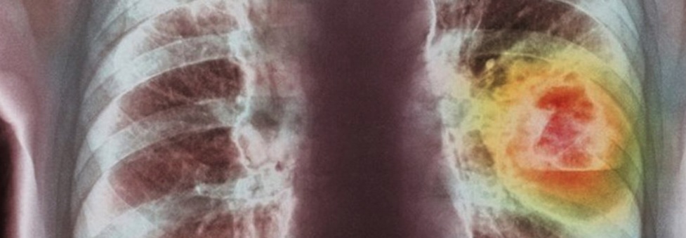Мелкоклеточный рак легкого фото рентген