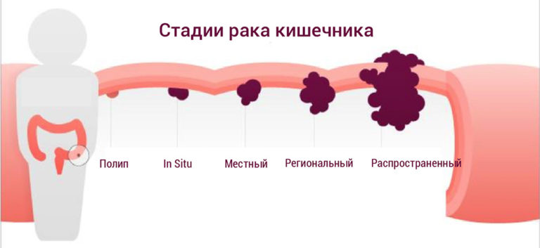 При раке кишечника цвет стула