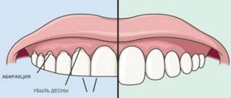 фото разница бруксизм и здоровые зубы