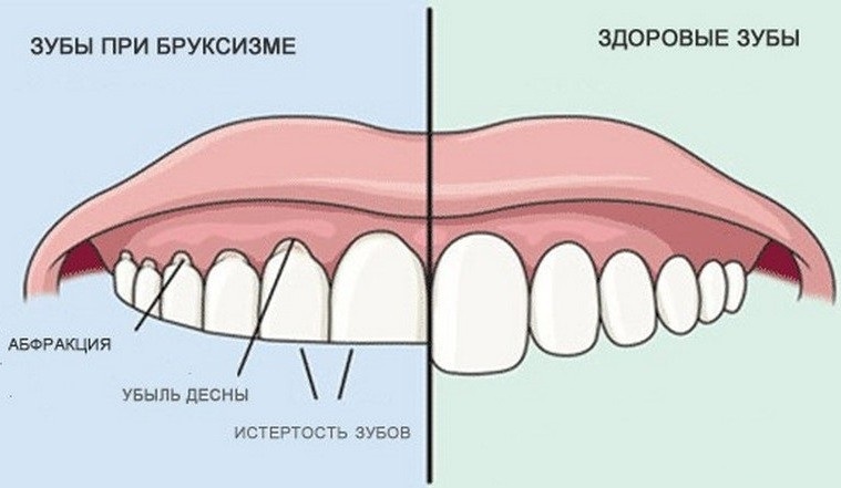 фото разница бруксизм и здоровые зубы