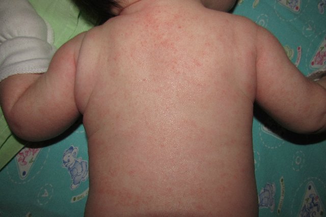 Атопический дерматит у младенца на спине фото
