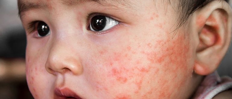 Атопический дерматит у ребенка на лице фото