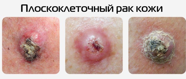 Плоскоклеточный рак кожи фото