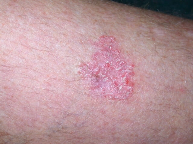 Плоскоклеточный рак кожи фото на ноге
