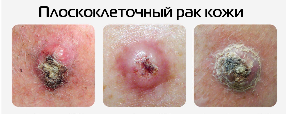 Плоскоклеточный рак кожи фото