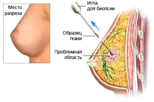 биопсия при раке груди фото