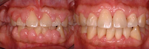 десны на зубах операция до и после фото