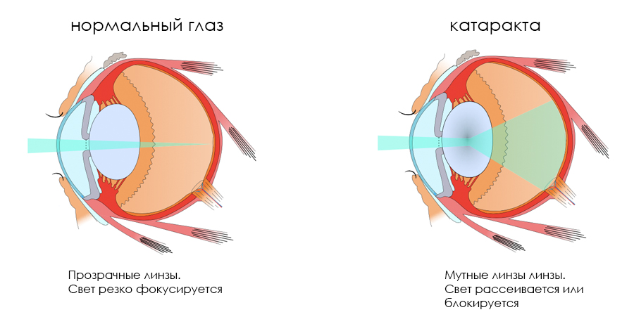 Катаракта картинки биология