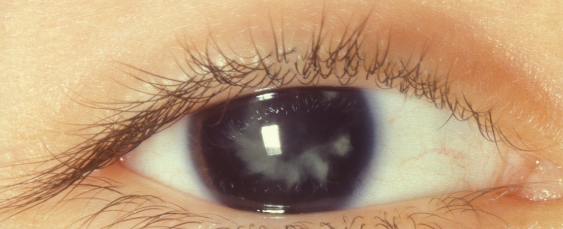 Вторичная катаракта фото