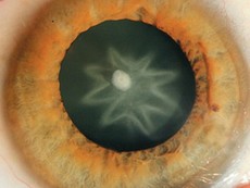 Травматическая катаракта фото