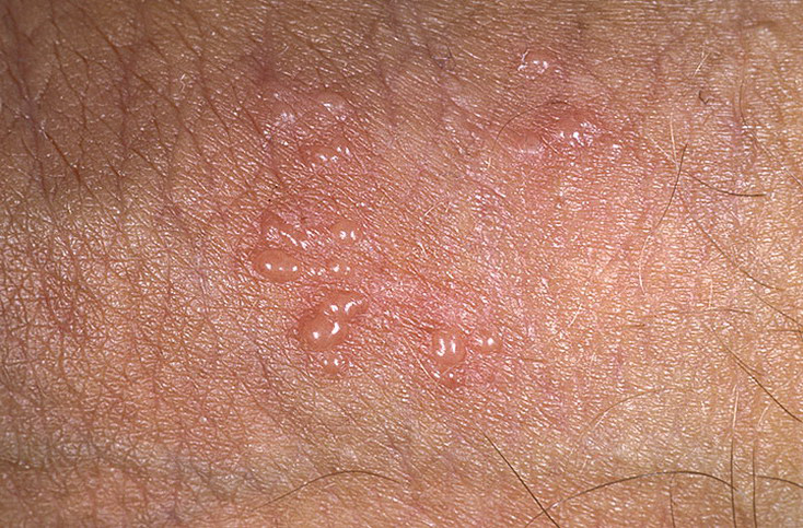 Герпес У Мужчин Фото