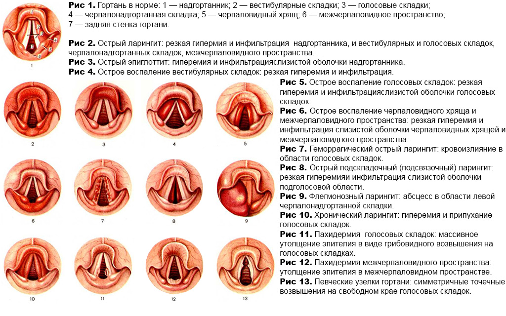 Схема лечения ларингита у взрослых