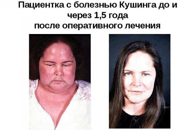 Синдром Кушинга фото до и после лечения