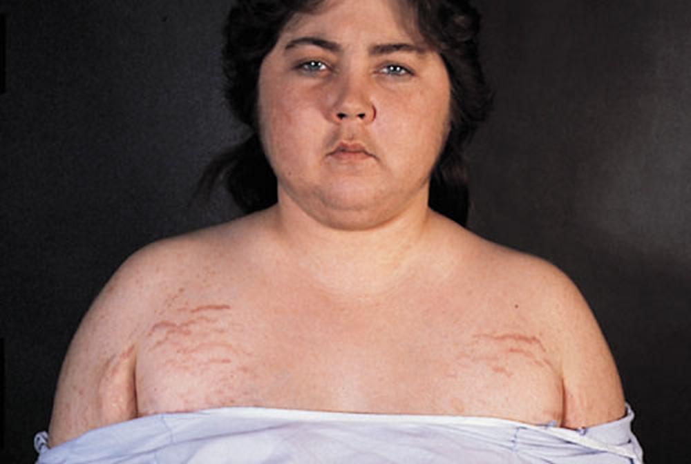 Синдром Кушинга фото у женщины