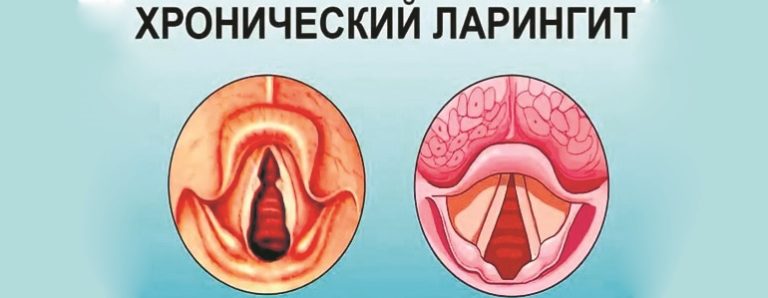 Хронический ларингит: фото, лечение у детей и взрослых - Фото болезней