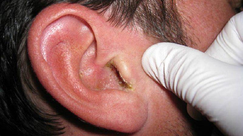 Вид уха при отите фото thumbnail