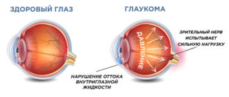 Глаукома фото