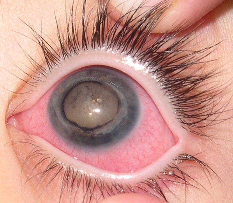 Глаукома фото глаза