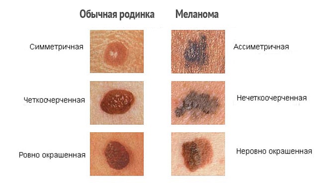 Злокачественная меланома фото
