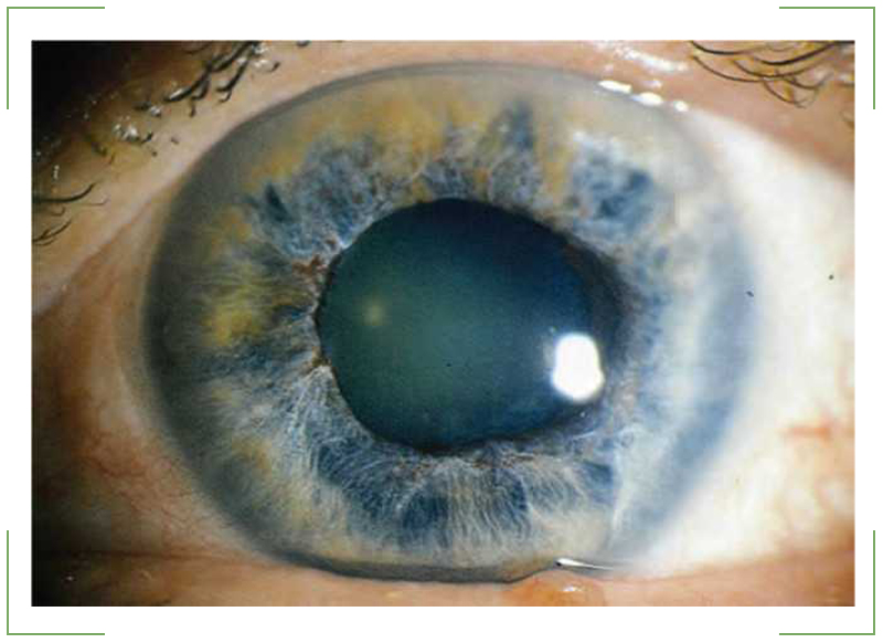 Открытоугольная глаукома фото