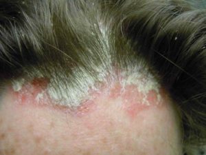 Себорейный дерматит кожи головы лечение фото