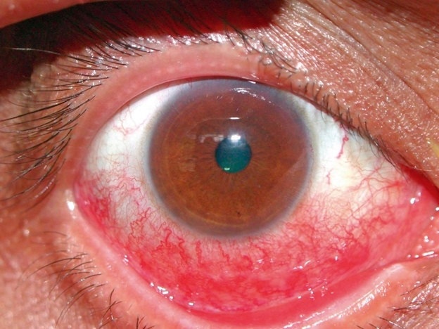 Синдром сухого глаза симптом на фото