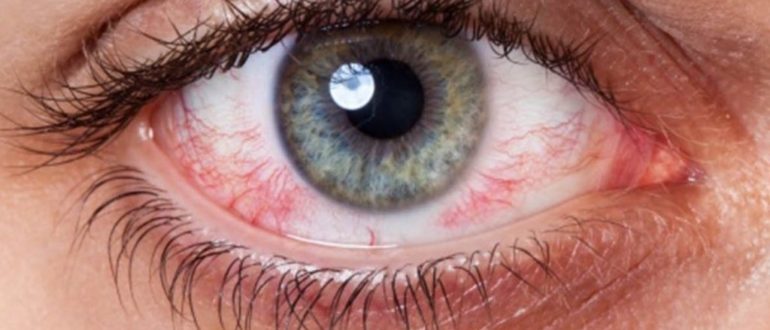Синдром сухого глаза фото