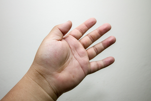 синдром шерешевского тёрнера фото рук