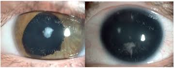 аниридия фото глаза